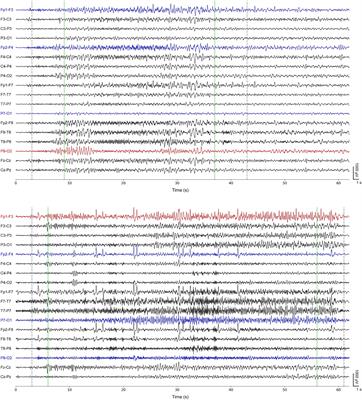 Single-channel seizure detection with clinical confirmation of seizure locations using CHB-MIT dataset